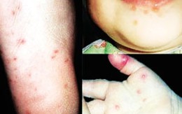 Nguy hiểm từ bệnh TCM: Mối lo của các bậc phụ huynh