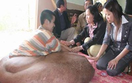 Hoãn phẫu thuật cho bệnh nhân có khối u 90kg