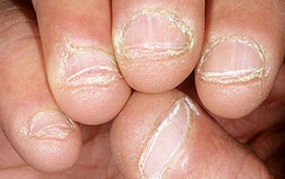 Chẩn bệnh qua...9 kiểu móng tay  