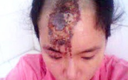 Nữ nhân viên của phường bị chồng tạt axít