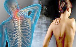 Ngủ kém gây đau cơ xơ hóa ở phụ nữ 