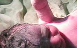 Dị tật bẩm sinh - Một vấn đề của chất lượng dân số