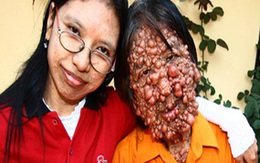 Người đàn ông mọc hàng nghìn bong bóng khắp cơ thể