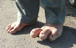 Người đàn ông có 3 ngón chân to bằng... cổ tay