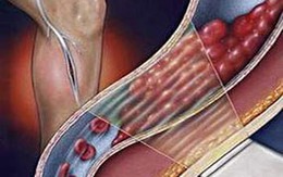 Những dấu hiệu bệnh viêm tắc động mạch 