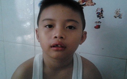 Cô giáo làm học sinh tiểu học gãy răng