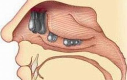 Chảy nước mắt sống, vì sao?
