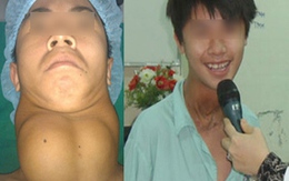 Cắt khối u dài cả gang tay trên cổ sau 17 năm