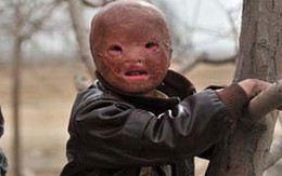Xót xa đời cậu bé "không có mặt"