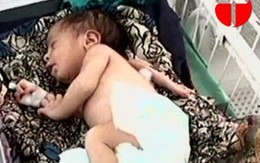 Bé gái ra đời với... 3 tay 