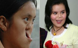 Cô gái “mặt ma” đã có thể mỉm cười