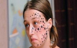 Nỗi khổ của cô gái mặt có 56 ngôi sao 