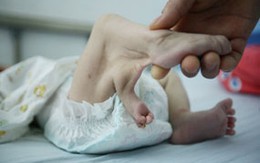 Bé gái sơ sinh bị cha mẹ bỏ rơi vì có…3 chân