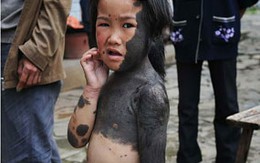 Cô bé “người sói” bị bố mẹ bỏ rơi (!)
