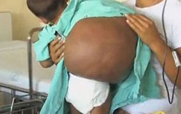 Bé 2 tuổi “cõng” khối u 15 kg