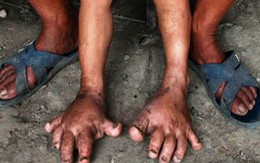 Bé gái 3 tuổi có đôi chân "quái vật"