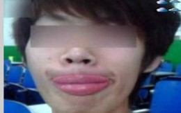 Môi sưng tướng vì bị ‘hôn trộm’