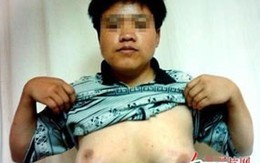 Ngực to bất thường vì thi đại học