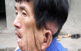 Người đàn ông có khuôn mặt 'tan chảy' 