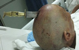 Ghê sợ tự đâm dao vào đầu vẫn sống