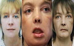 Người đàn bà được ghép mặt sống ra sao?