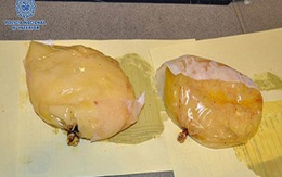Rùng mình cấy "độn ngực" bằng 1,3kg cocaine