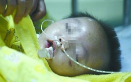 Bé 2 tuổi bị mẹ kế đánh gần chết