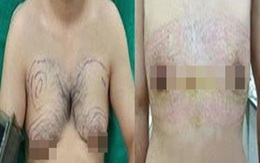 Chàng trai có bộ ngực "đồ sộ" như phụ nữ