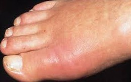 Phòng ngừa biến chứng ở bệnh nhân gút