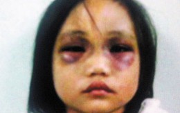 Bé gái 5 tuổi bị cha hành hạ tàn nhẫn