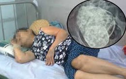 Hiện tượng hy hữu bà cụ 76 tuổi mang thai: Tuổi của thai đá ít nhất là 27 năm