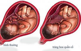 Khánh Hòa: Cứu sống trẻ sơ sinh bị “tràng hoa quấn cổ”