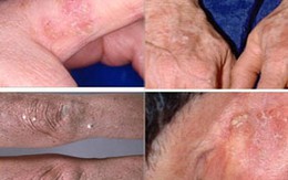 Bệnh da mùa hè: Phòng chống dày sừng ánh sáng