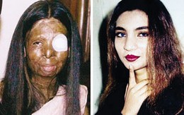 Kinh hoàng nạn tạt axit ở Pakistan