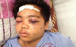 Nam sinh bị 34 mảnh đạn găm vào mặt