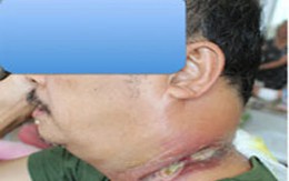 Suýt mất mạng vì tin lời thầy lang