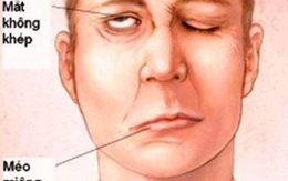 Dễ méo miệng, liệt mặt vì thức khuya