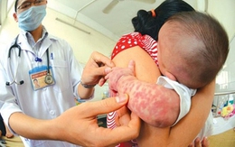 Thanh Hóa: Ghi nhận 375 bệnh nhân có triệu chứng nghi sởi