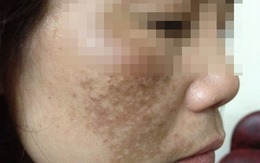 Mất tiền, hỏng da vì dùng kem chống nắng