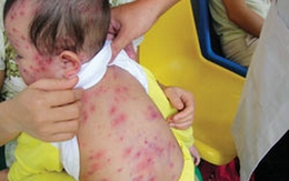 Lo ngại dịch chồng dịch