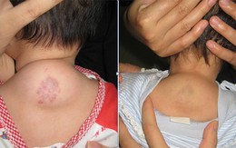 Những loại bệnh... "không cần chữa" ở trẻ em