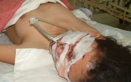 Bị thương nặng vì nổ bình khí hydro bơm bóng bay