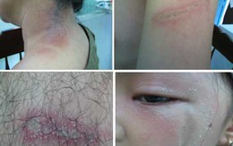 Rợn người hình ảnh lở loét da do côn trùng