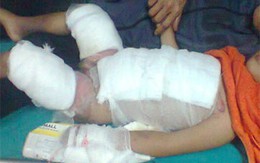 Bé 4 tuổi bỏng nặng vì nồi cháo anh nấu