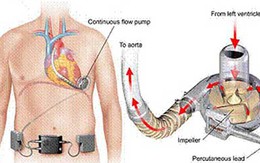 Kỳ lạ, thiếu nữ sống nhờ trái tim để trong túi xách
