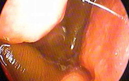 Con vắt béo núc ních sống trong mũi bệnh nhân