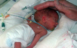 Sức sống mãnh liệt của bé sơ sinh nặng 600 g