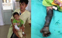 Kinh hãi bé bị hoại tử cánh tay do cha mẹ tự chữa bỏng
