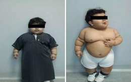 Cậu bé "siêu béo" được phẫu thuật dạ dày để giảm cân