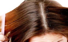 8 cách trị gàu hiệu quả nhất